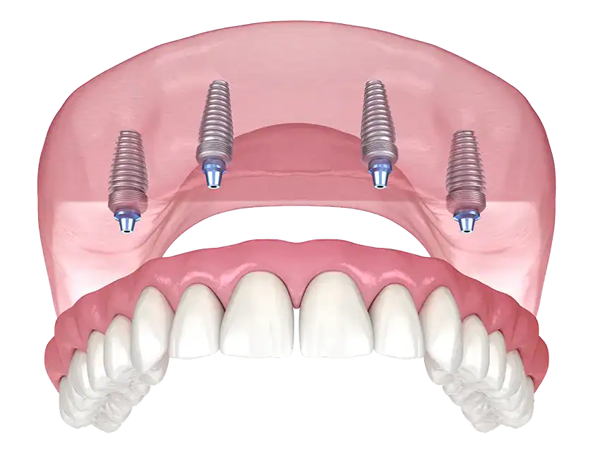 All-on-4 Implants at Tammy N. Tran, D.D.S., Inc. in Long Beach, CA