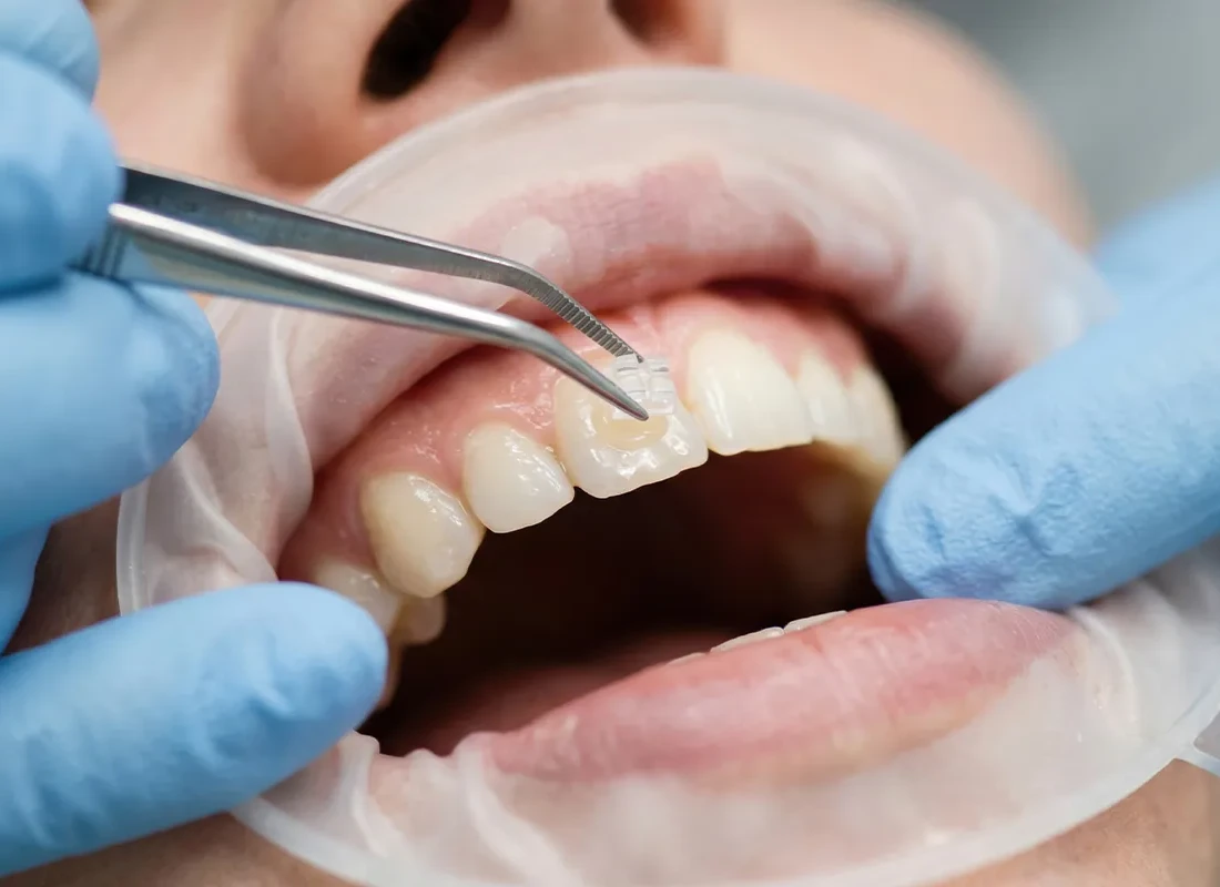 Dental Bonding at Tammy N. Tran, D.D.S., Inc. in Long Beach, CA