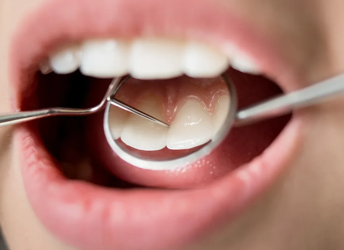 Teeth Cleaning (Prophy) at Tammy N. Tran, D.D.S., Inc. in Long Beach, CA