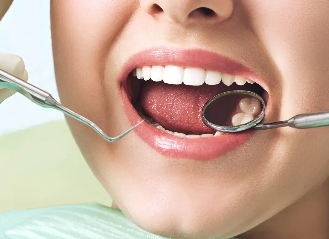 Tooth-Colored Fillings at Tammy N. Tran, D.D.S., Inc. in Long Beach, CA