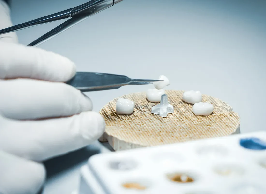 Signs you may need Dental Crowns — Tammy N. Tran, D.D.S., Inc.