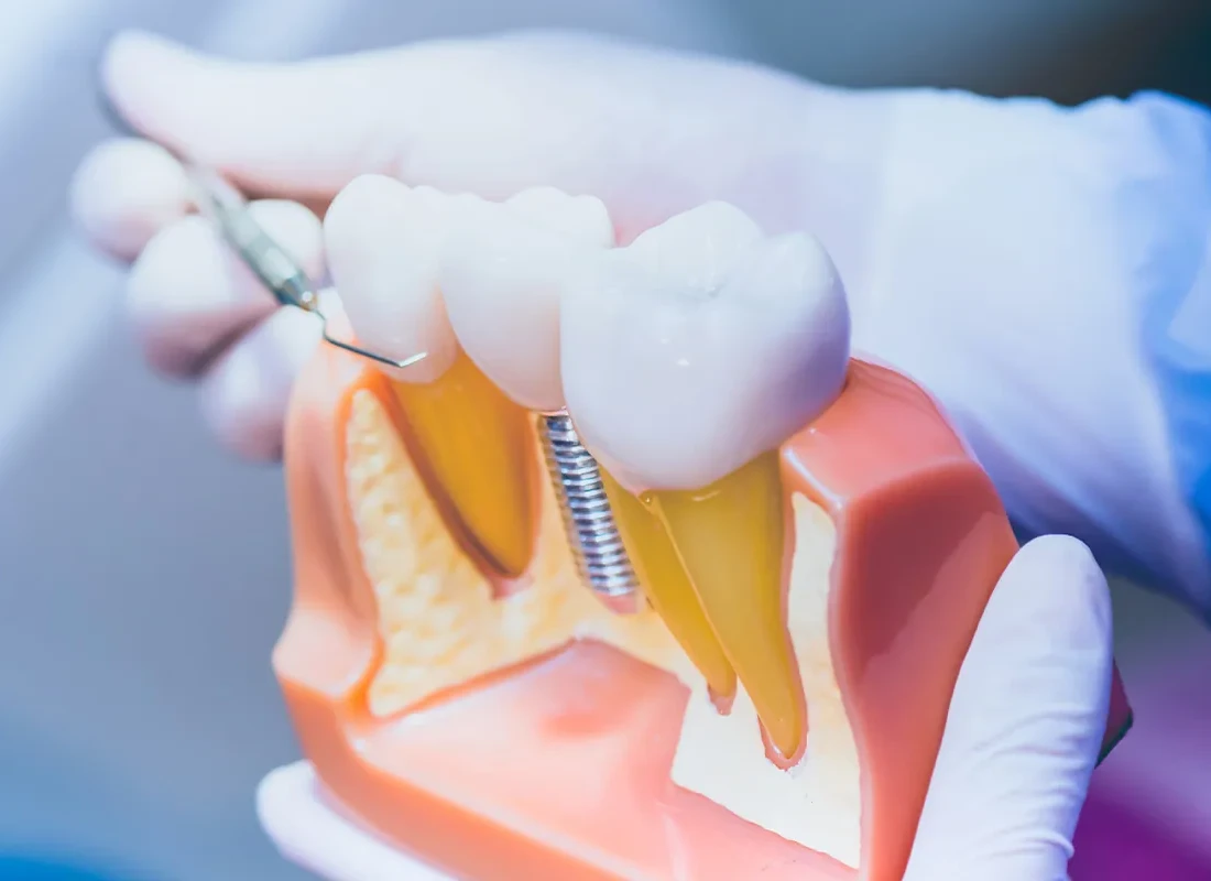 Dental Implants at Tammy N. Tran, D.D.S., Inc. in Long Beach, CA