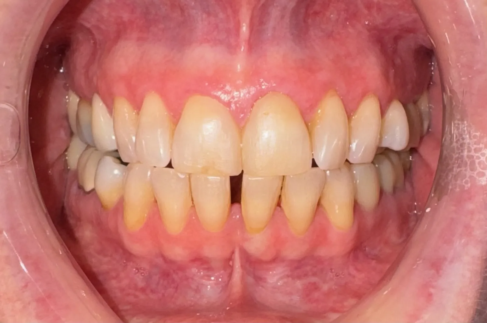 After dental bonding at Tammy N. Tran, D.D.S., Inc. in Long Beach, CA — Chipped edges and a small gap smoothed away with tooth-colored resin.