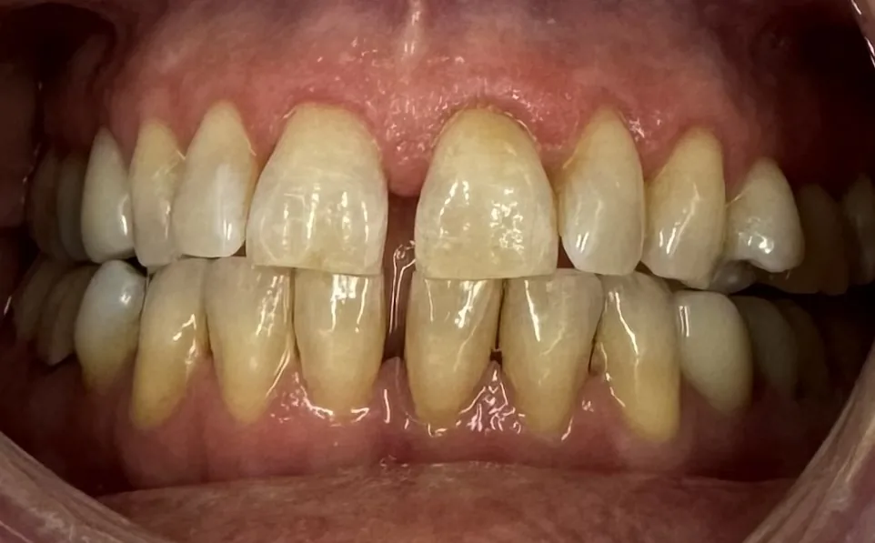 Before dental bonding at Tammy N. Tran, D.D.S., Inc. in Long Beach, CA — Chipped edges and a small gap smoothed away with tooth-colored resin.