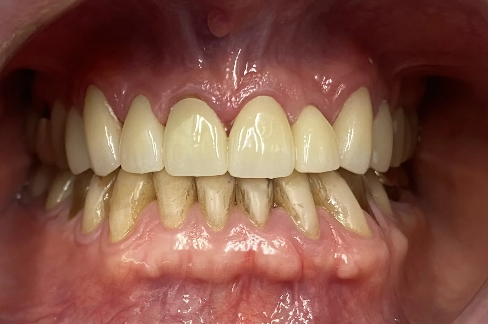 After dental crowns at Tammy N. Tran, D.D.S., Inc. in Long Beach, CA — Worn, discolored front teeth rebuilt with custom porcelain crowns.