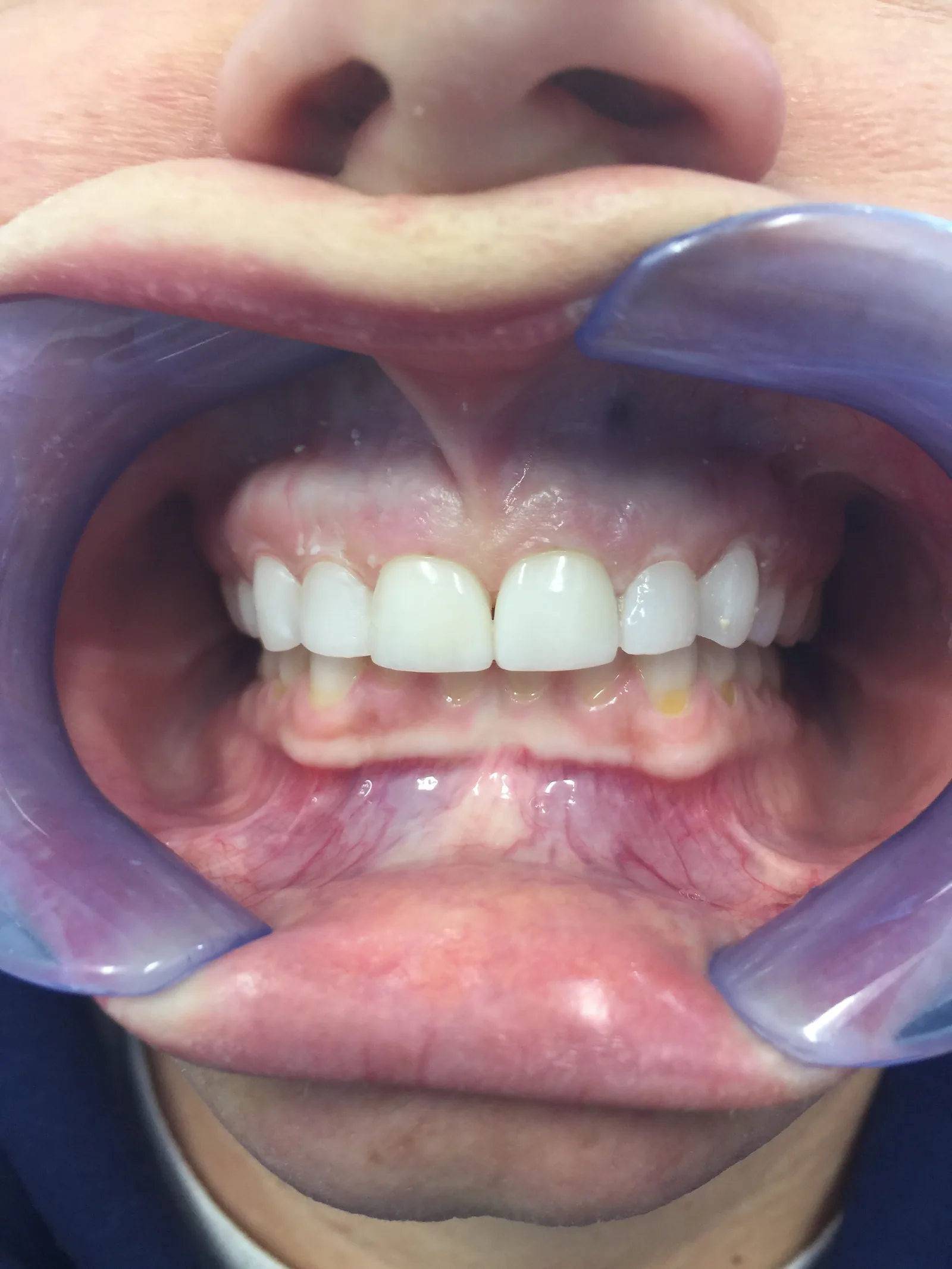 After dental crowns at Tammy N. Tran, D.D.S., Inc. in Long Beach, CA — A full upper restoration that rebuilt both shape and color.