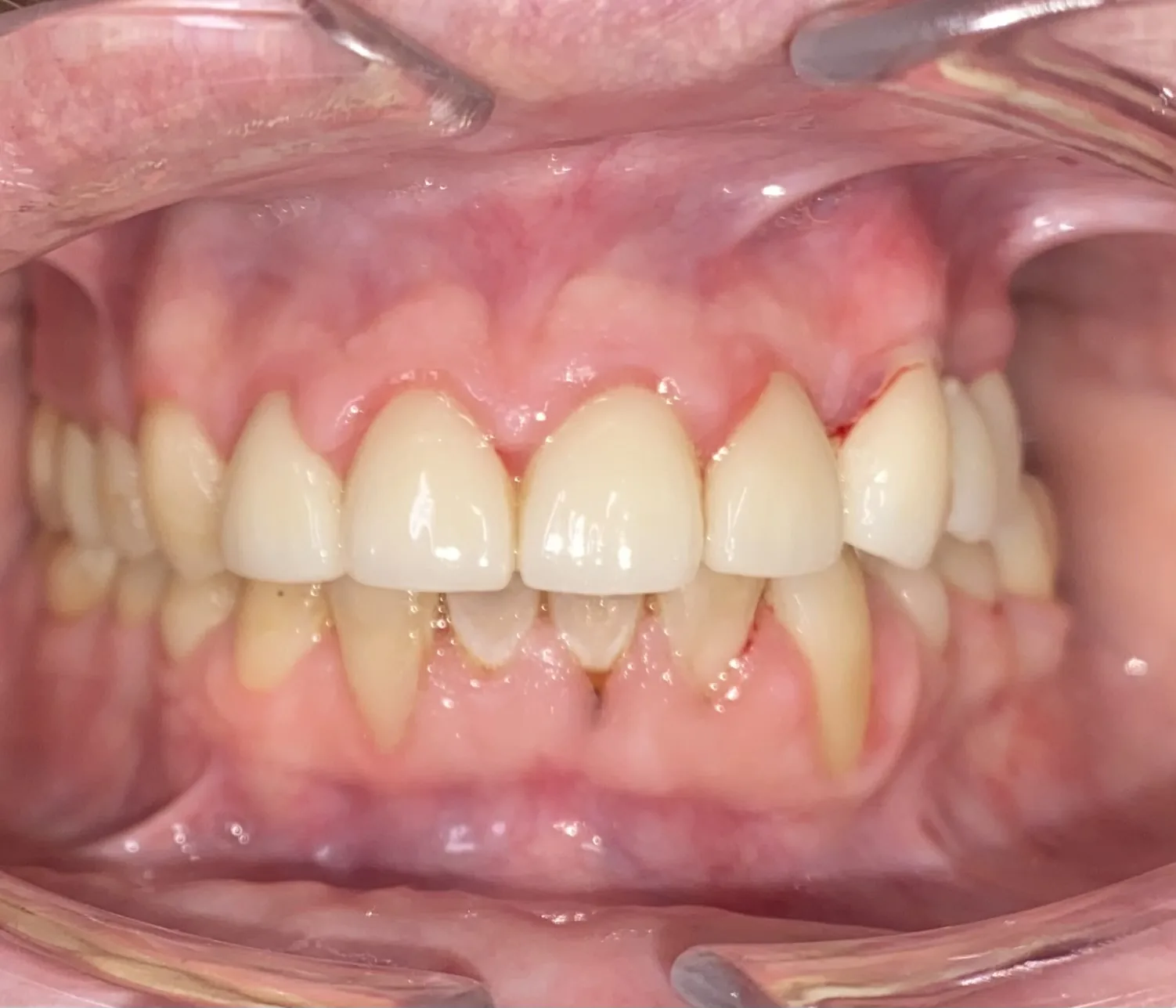 After dental crowns at Tammy N. Tran, D.D.S., Inc. in Long Beach, CA — Damaged teeth restored to a natural shape and a brighter, even shade.