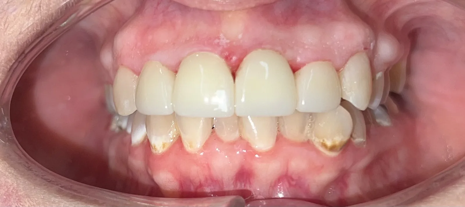 After dental crowns at Tammy N. Tran, D.D.S., Inc. in Long Beach, CA — Old restorations replaced with porcelain that blends into the smile.