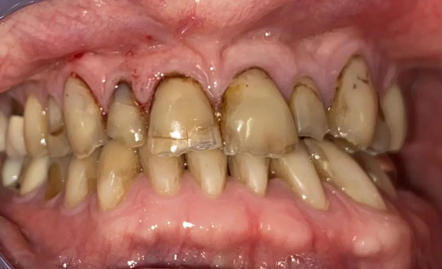 Before dental crowns at Tammy N. Tran, D.D.S., Inc. in Long Beach, CA — Worn, discolored front teeth rebuilt with custom porcelain crowns.