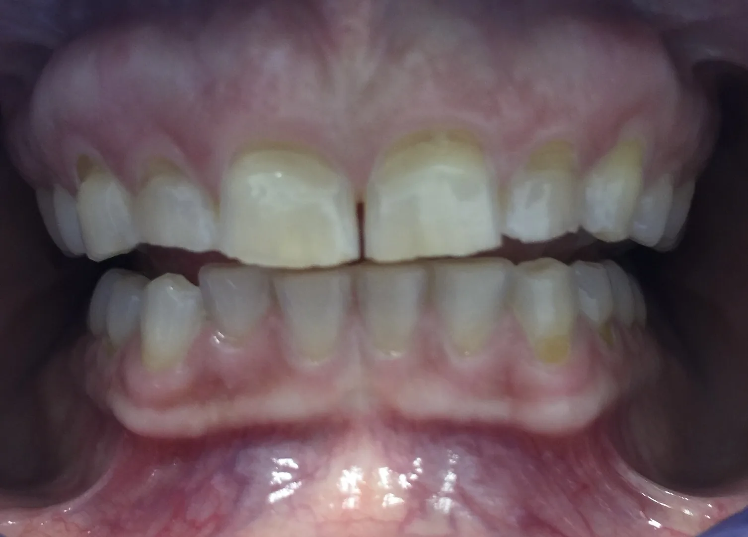 Before dental crowns at Tammy N. Tran, D.D.S., Inc. in Long Beach, CA — A full upper restoration that rebuilt both shape and color.