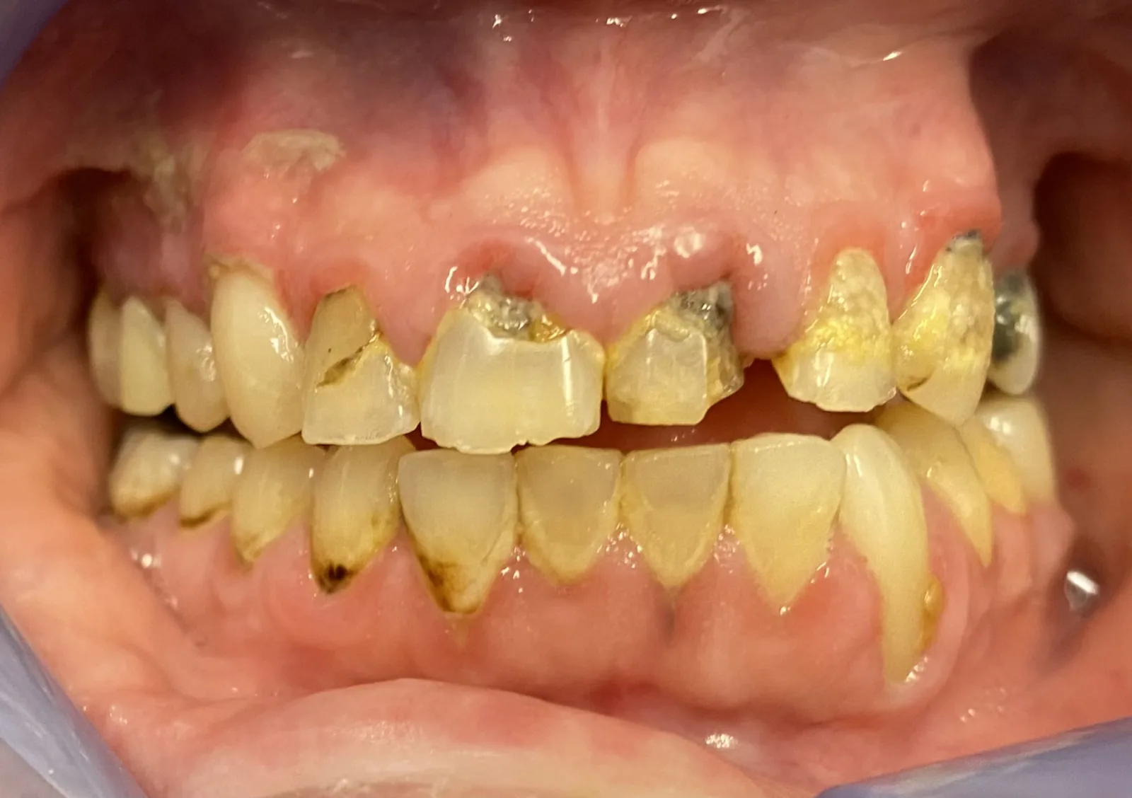 Before dental crowns at Tammy N. Tran, D.D.S., Inc. in Long Beach, CA — Damaged teeth restored to a natural shape and a brighter, even shade.