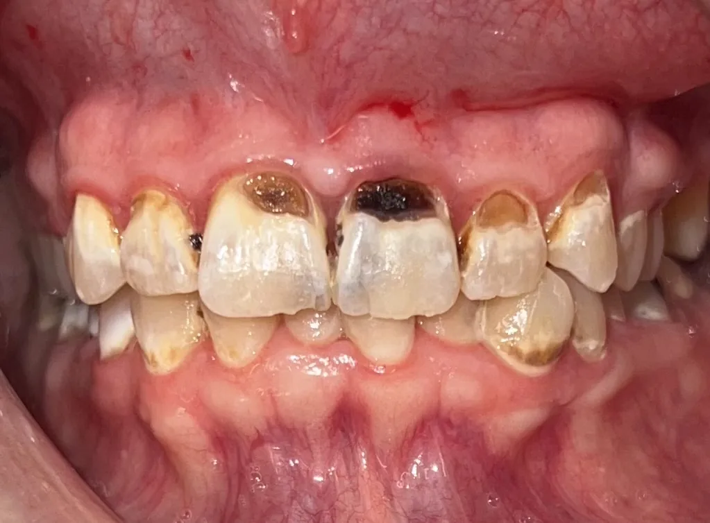 Before dental crowns at Tammy N. Tran, D.D.S., Inc. in Long Beach, CA — Old restorations replaced with porcelain that blends into the smile.