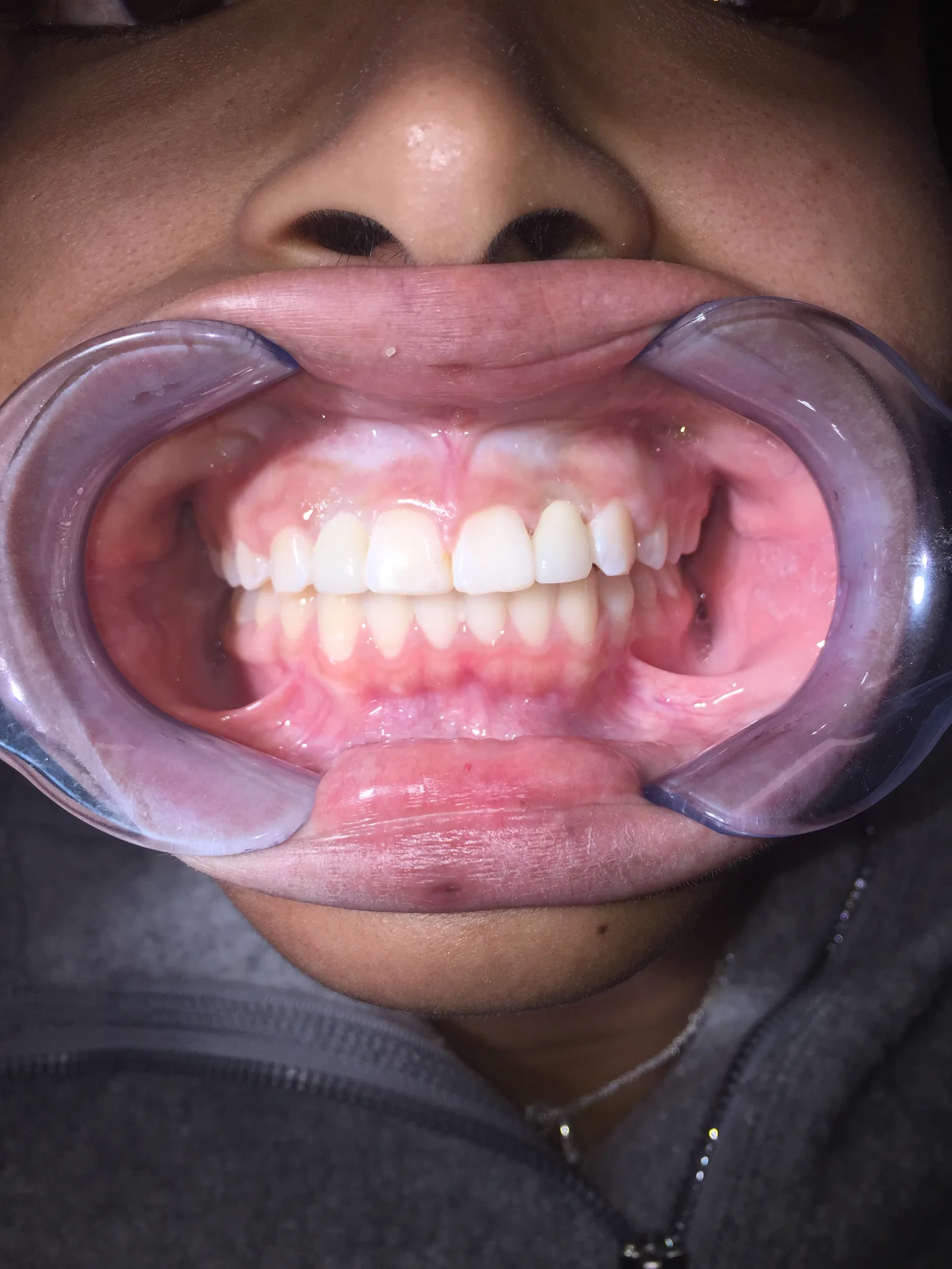 After dental implants at Tammy N. Tran, D.D.S., Inc. in Long Beach, CA — A missing tooth replaced with an implant and a shade-matched crown.