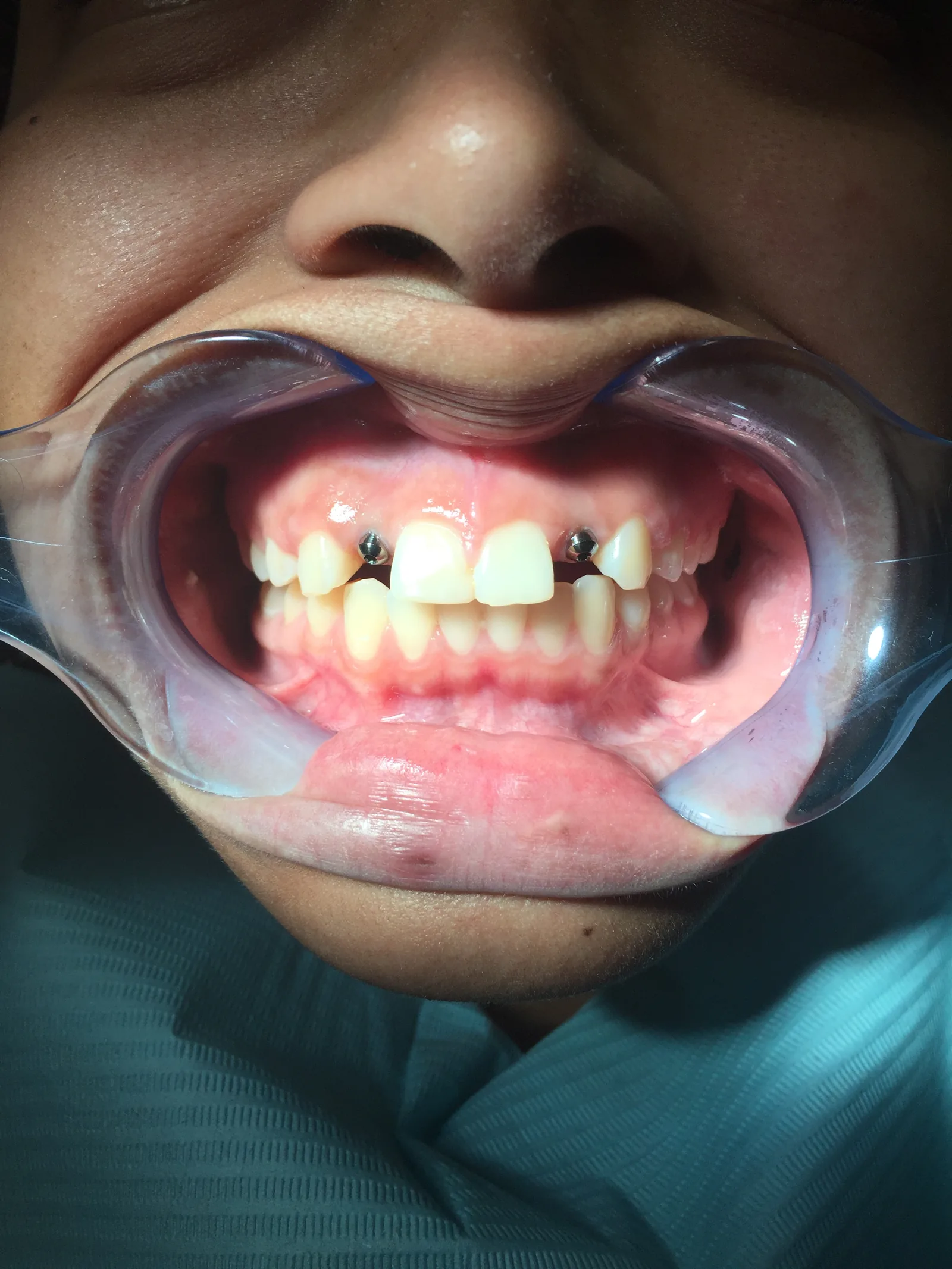 Before dental implants at Tammy N. Tran, D.D.S., Inc. in Long Beach, CA — A missing tooth replaced with an implant and a shade-matched crown.