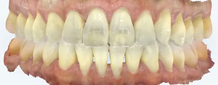 After invisalign at Tammy N. Tran, D.D.S., Inc. in Long Beach, CA — Crowding and an uneven front edge brought into line with clear aligners.
