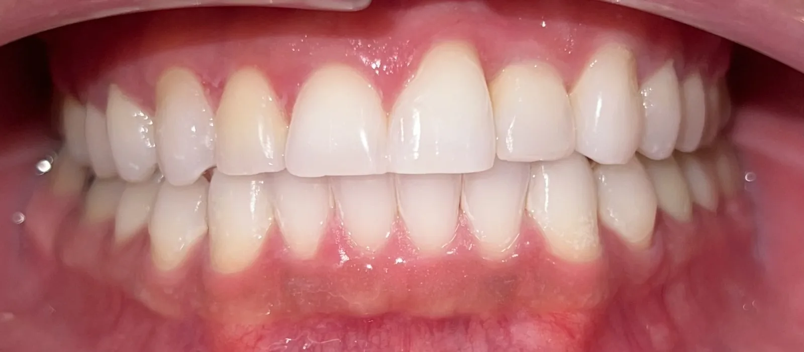 After invisalign at Tammy N. Tran, D.D.S., Inc. in Long Beach, CA — Spacing closed and the bite evened out, with no metal brackets.