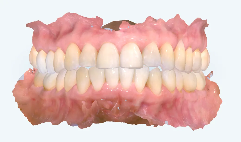 After invisalign at Tammy N. Tran, D.D.S., Inc. in Long Beach, CA — Overlapping upper teeth guided into an even, uniform arch.