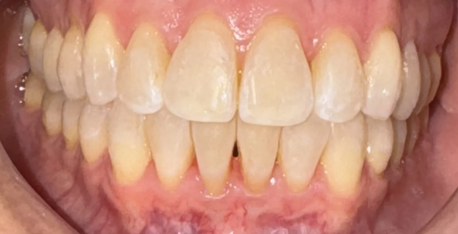 After invisalign at Tammy N. Tran, D.D.S., Inc. in Long Beach, CA — Crowding relieved and the midline corrected over a course of aligners.