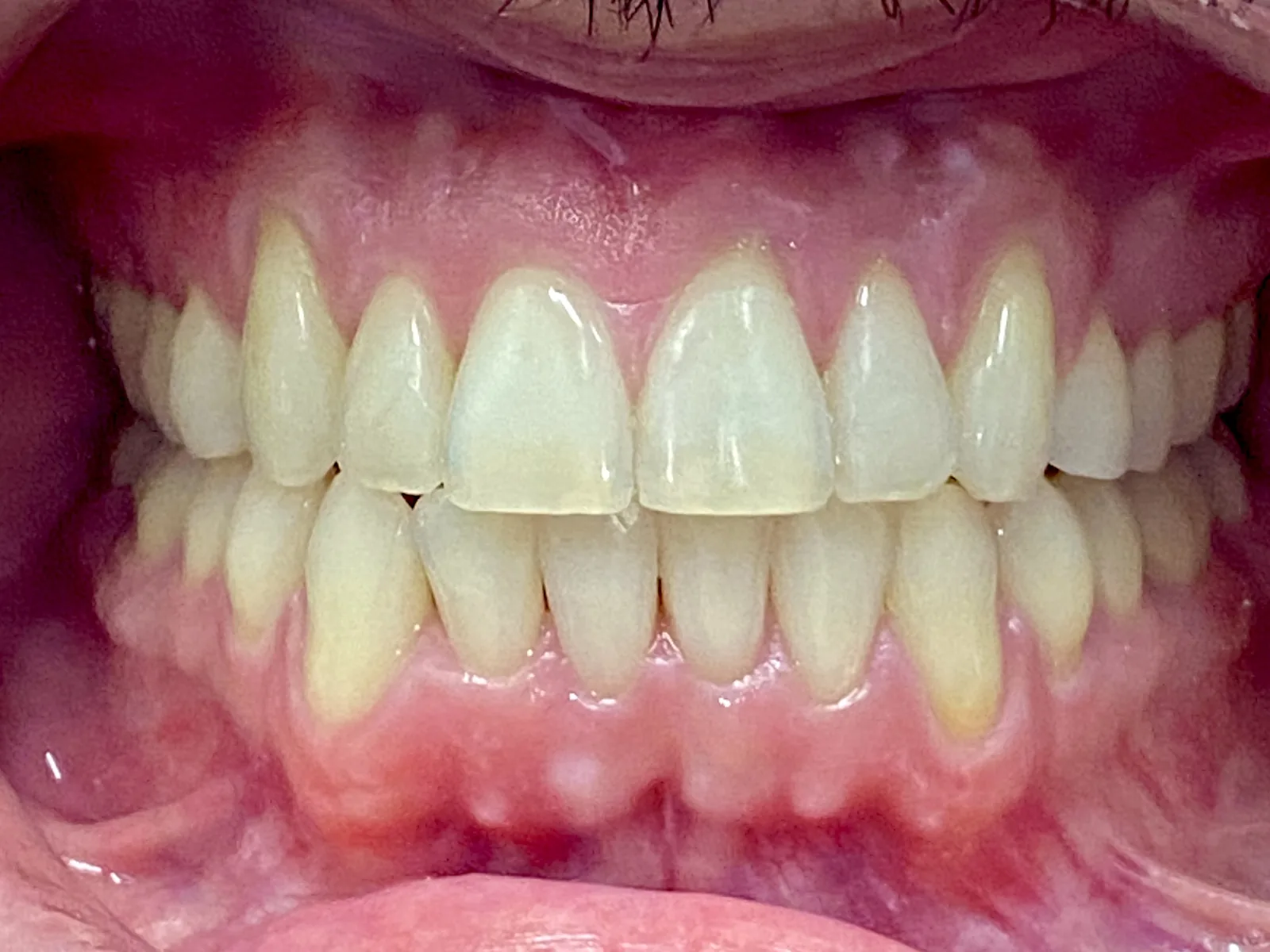 After invisalign at Tammy N. Tran, D.D.S., Inc. in Long Beach, CA — A rotated front tooth turned into place for an even smile line.