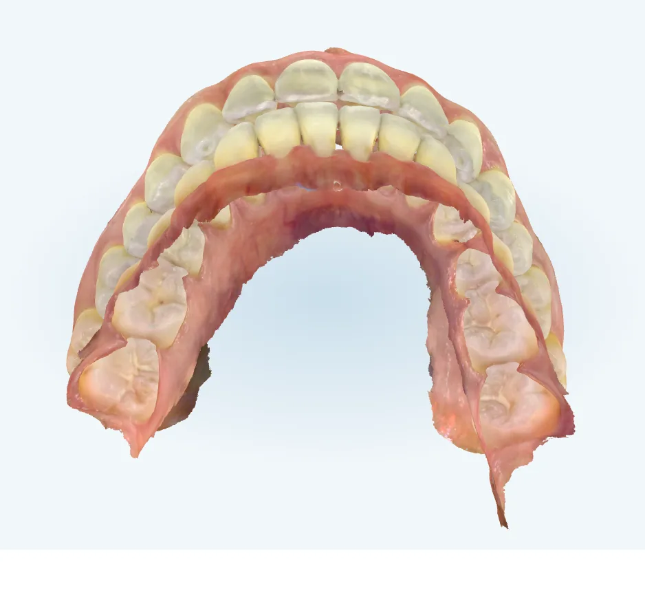 After invisalign at Tammy N. Tran, D.D.S., Inc. in Long Beach, CA — Gaps closed and edges leveled, finished with a retainer to hold it.