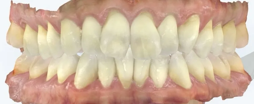 Before invisalign at Tammy N. Tran, D.D.S., Inc. in Long Beach, CA — Crowding and an uneven front edge brought into line with clear aligners.
