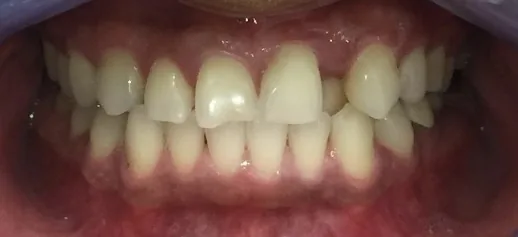 Before invisalign at Tammy N. Tran, D.D.S., Inc. in Long Beach, CA — Spacing closed and the bite evened out, with no metal brackets.
