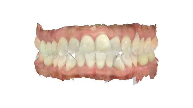 Before invisalign at Tammy N. Tran, D.D.S., Inc. in Long Beach, CA — Overlapping upper teeth guided into an even, uniform arch.