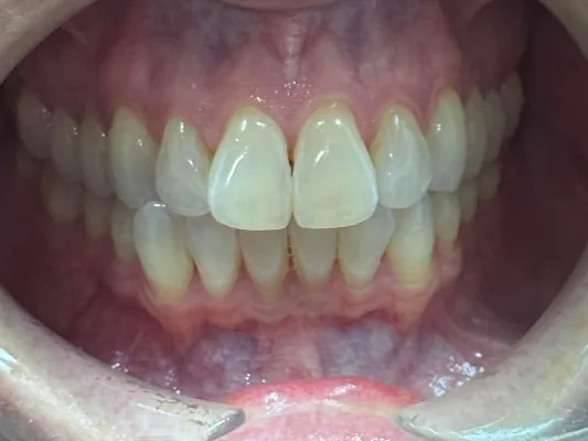 Before invisalign at Tammy N. Tran, D.D.S., Inc. in Long Beach, CA — Crowding relieved and the midline corrected over a course of aligners.
