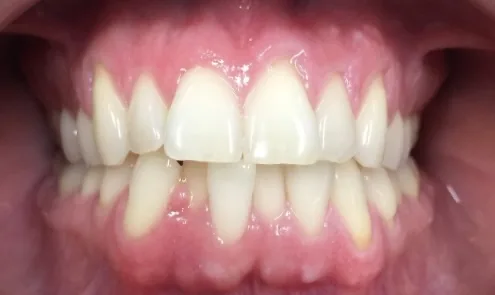 Before invisalign at Tammy N. Tran, D.D.S., Inc. in Long Beach, CA — A rotated front tooth turned into place for an even smile line.