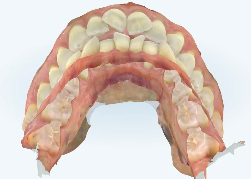 Before invisalign at Tammy N. Tran, D.D.S., Inc. in Long Beach, CA — Gaps closed and edges leveled, finished with a retainer to hold it.
