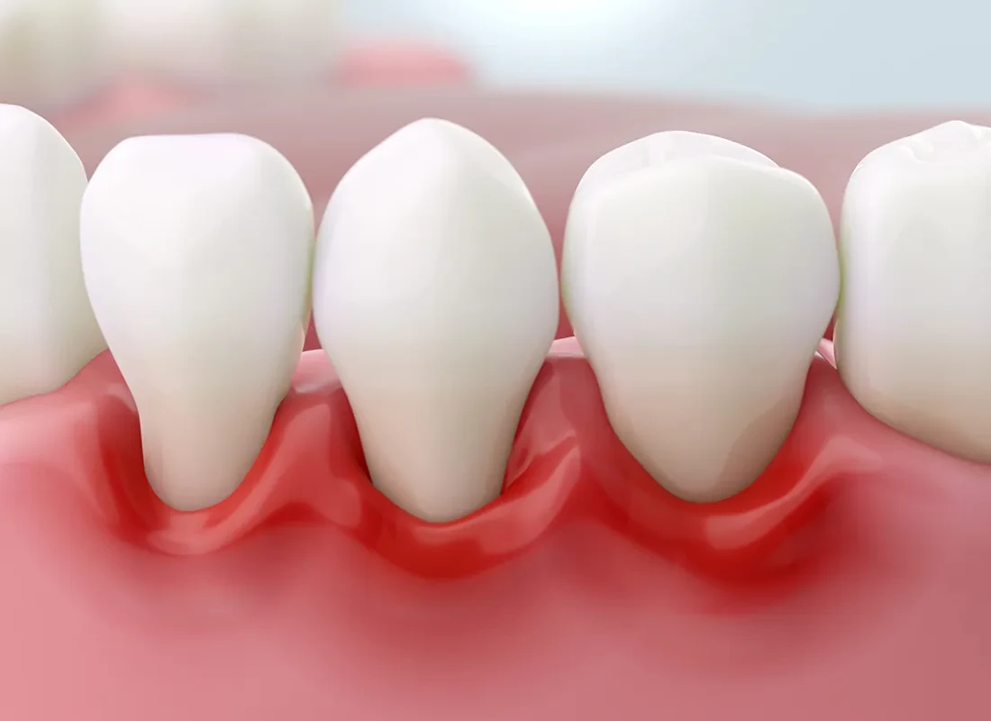 Periodontal Care at Tammy N. Tran, D.D.S., Inc. in Long Beach, CA