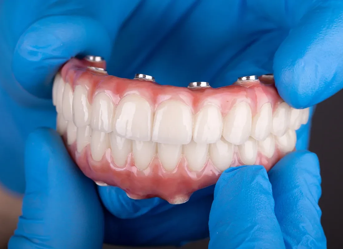 Signs you may need All-on-4 Implants — Tammy N. Tran, D.D.S., Inc.