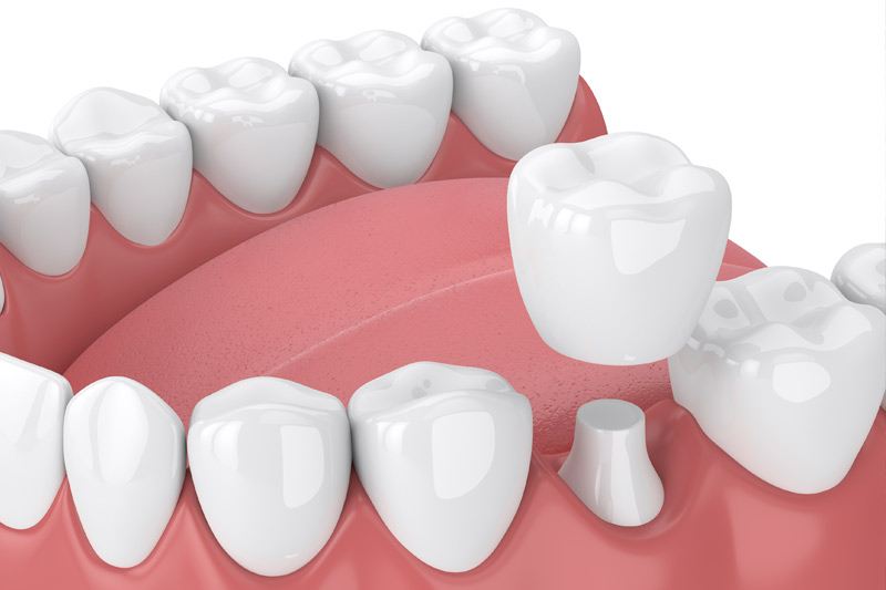 Dental Crowns in Long Beach