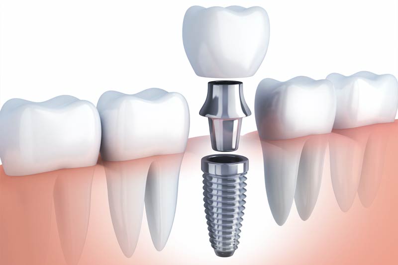 Implants Dentist in Long Beach