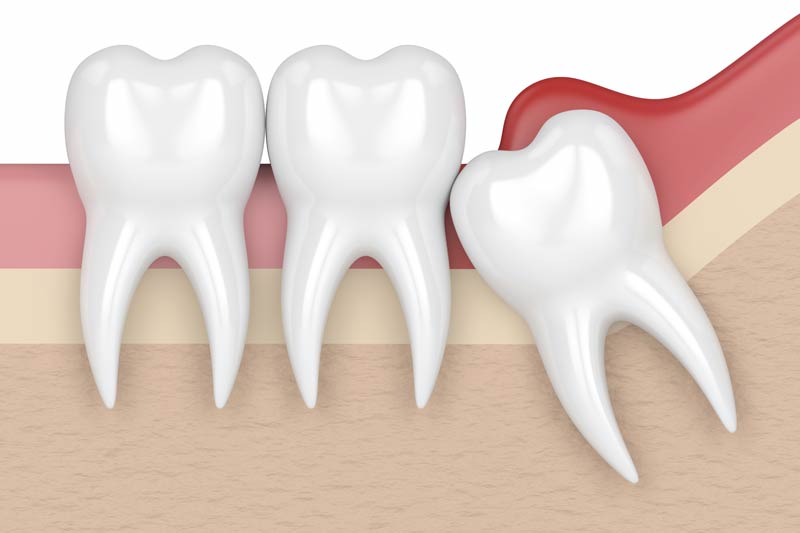 Wisdom Tooth Removal in Long Beach