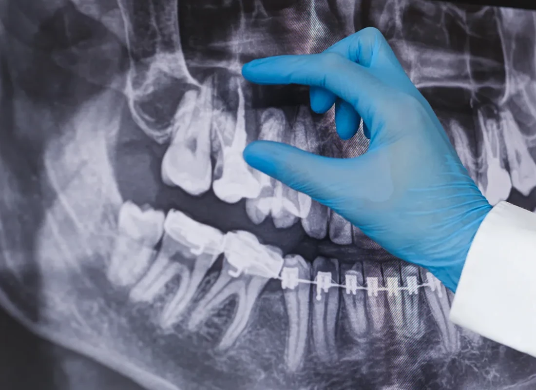 Signs you may need Root Canal — Tammy N. Tran, D.D.S., Inc.