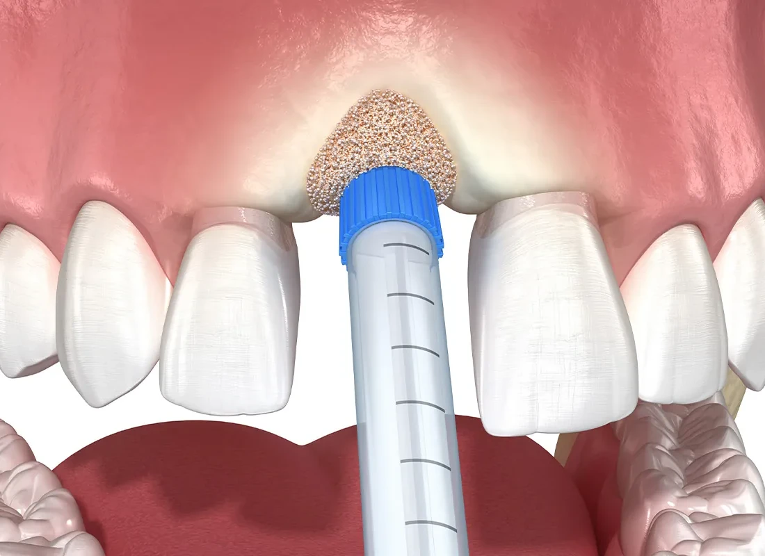Sinus Lift at Tammy N. Tran, D.D.S., Inc. in Long Beach, CA