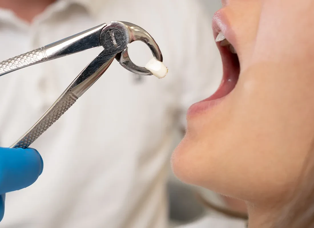 Tooth Extraction at Tammy N. Tran, D.D.S., Inc. in Long Beach, CA