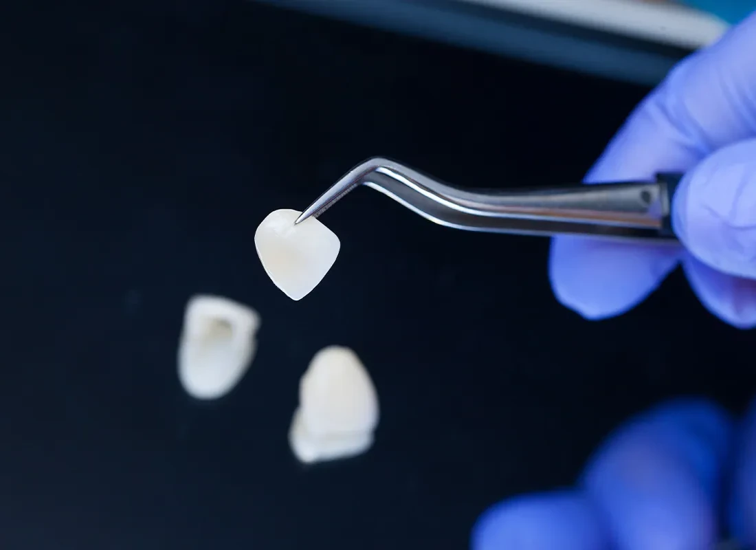 Signs you may need Cosmetic Veneers — Tammy N. Tran, D.D.S., Inc.