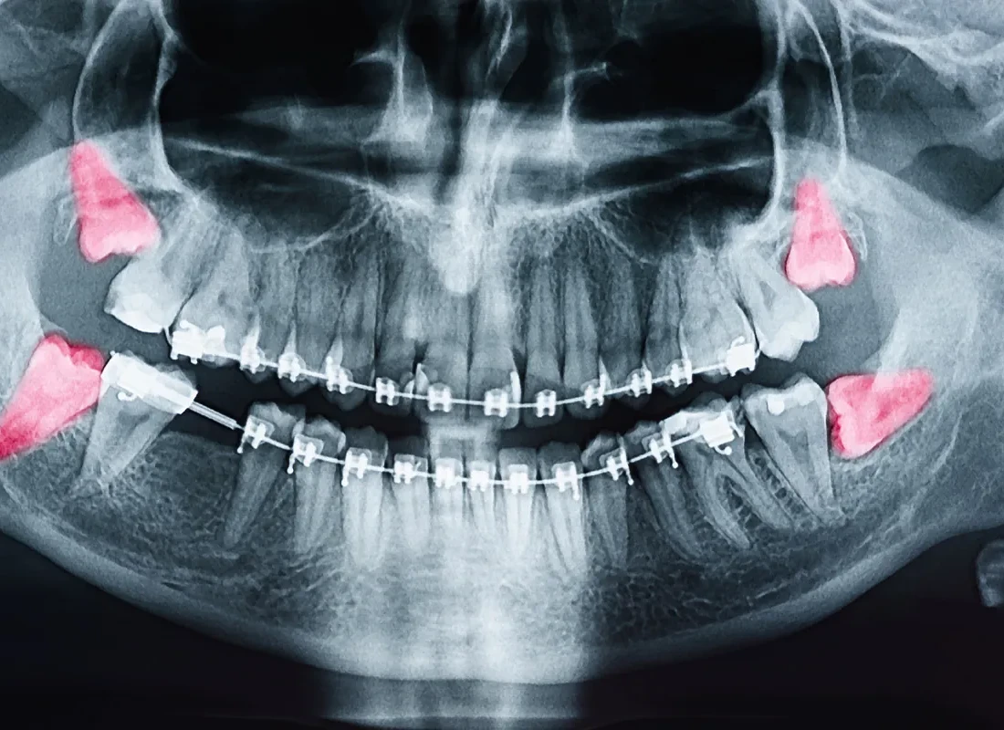 Wisdom Teeth Removal at Tammy N. Tran, D.D.S., Inc. in Long Beach, CA